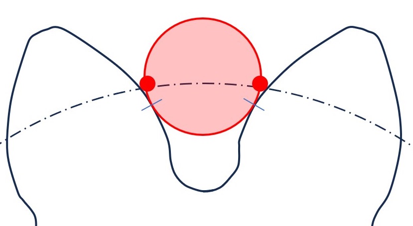 MdK-Messung in Ein- oder Zweiflankenanlage?